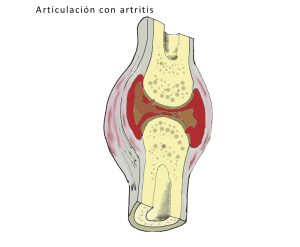 articulacion artritis